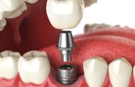 (( زراعة الأسنان Dental implant ))